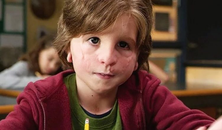 Auggie from the film “Wonder” is unrecognizable in real life since he ...